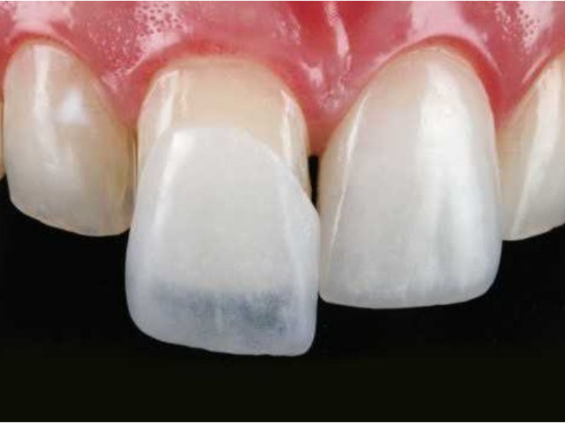 Lentes de Contato Dental